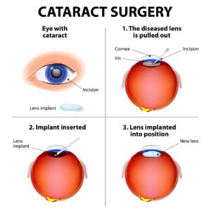 Cataract Surgery Fort Lauderdale FL