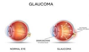 Glaucoma Treatment Miami, FL
