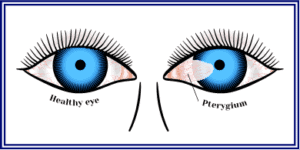 Pterygium Treatment Miami, FL