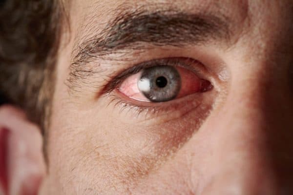 Bloodshot Eyes: Should you be concerned?