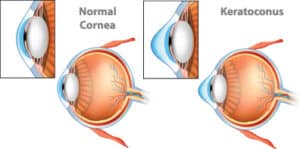 Keratoconus Treatment in Miami