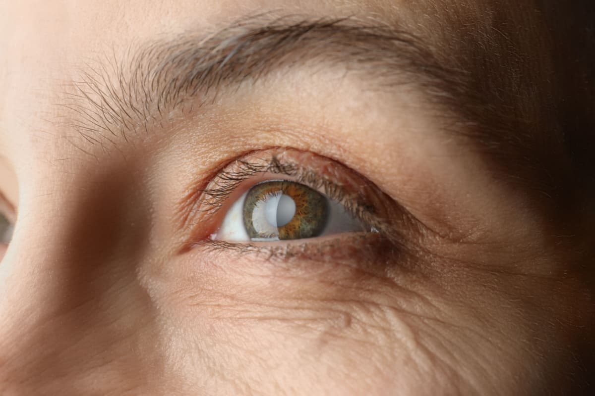 Cataract Surgery in Miami correct refractive errors like astigmatism, nearsightedness, or farsightedness, also you may see even better than you did before having cataracts.
