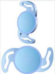 Two IOL options for a patient seeking lens exchange in Miami.
