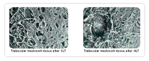 Fort Lauderdale Angle Closure Glaucoma treatment