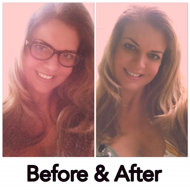 Before & after cataract surgery in Miami